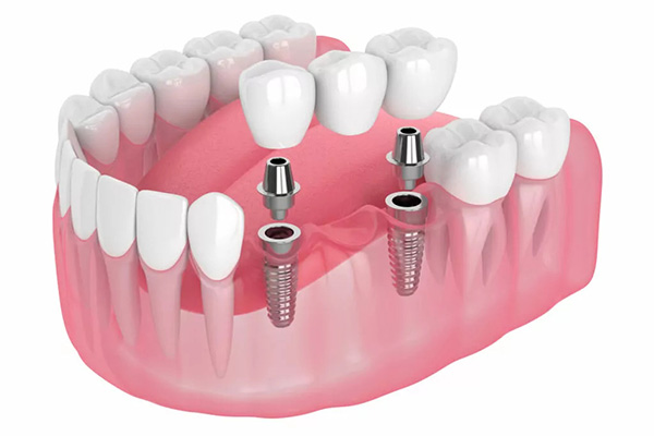 Dental-Crowns-and-Bridges