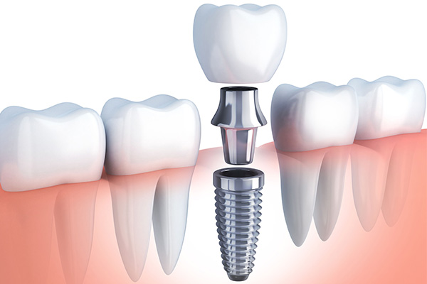 Dental-Implants