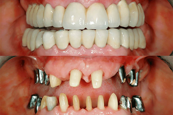 Before and After Full Mouth Rehabilitation results at Dev Multi Speciality Dental Care Ahmedabad