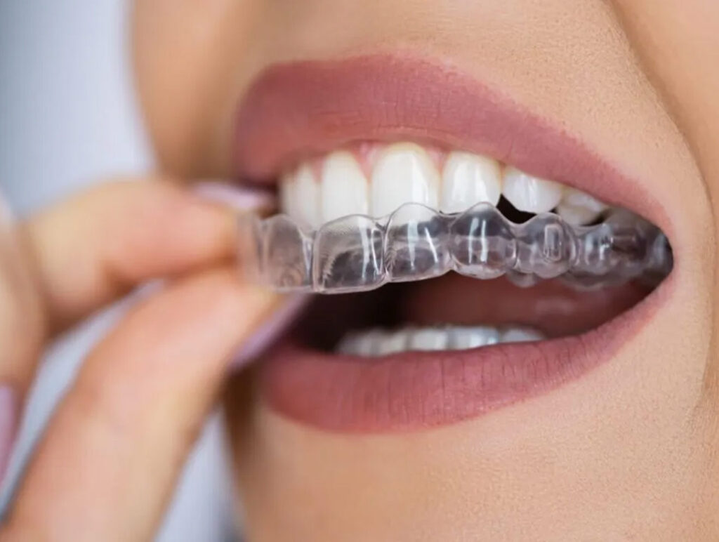 Top Dentist for Braces in Ahmedabad