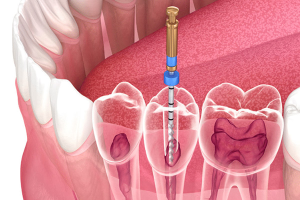 Root-Canal-Treatment