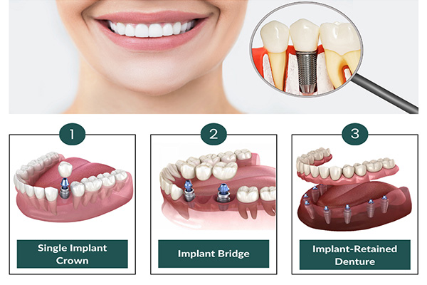 type-of-dental-implement
