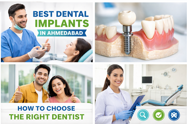 Best Dental Implants in Ahmedabad: How to Choose the Right Dentist Near You