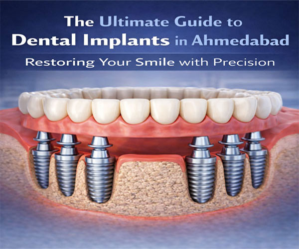 The Ultimate Guide to Dental Implants in Ahmedabad: Restoring Your Smile with Precision
