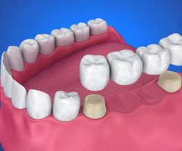 Dental Crowns and Bridges Treatments in Ahmedabad